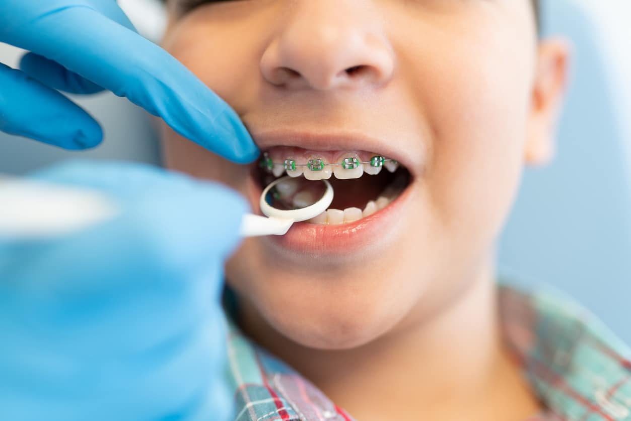 child braces best pediatric dentist calgary